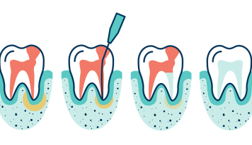 The Process Of root canal treatment