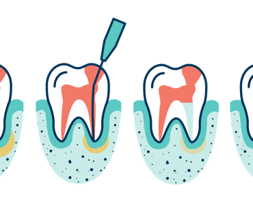 The Process Of root canal treatment