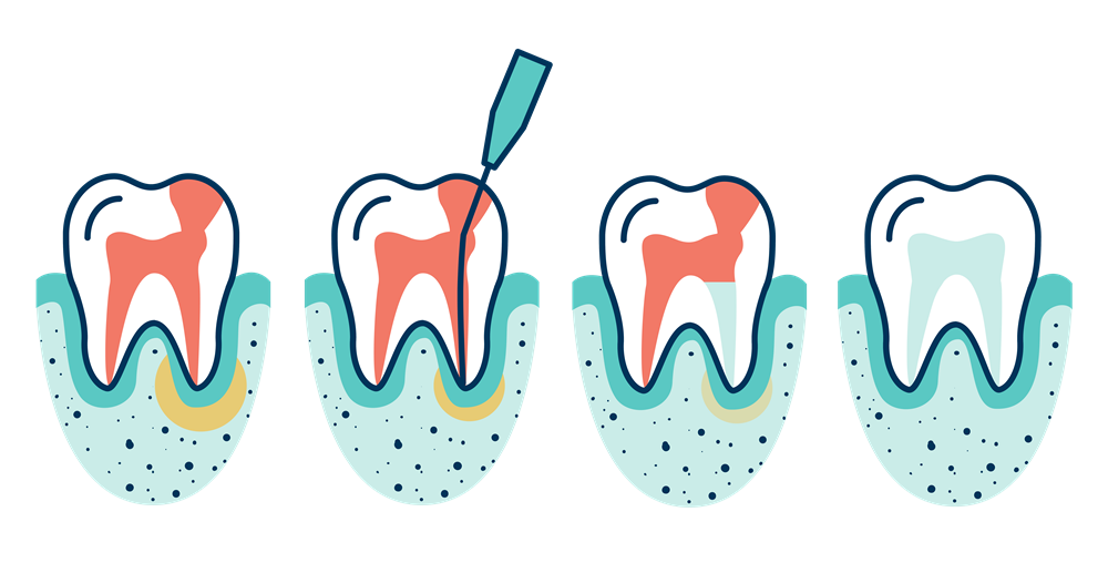 Root Canal Treatment